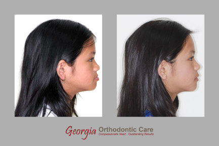 Underbite orthodontic treatment, early orthodontic treatment, phase I orthodontic treatment, facemask treatment, Georgia Orthodontic 
Care, Dr Nguyen, Orthodontic treatments, Orthodontists, Orthodontics, Cosmetic, Implant, Children, Family, Dentists, Clear, Braces, 
Invisible, Adults, Teens, Children, Clear Braces, Invisible Braces, Invisalign, Straighten, Teeth, Lawrenceville, Norcross, Buford, 
Hamilton Mill, Dacula, Auburn, Sugar Hill, Sugar Loaf, Doraville, Chamble...